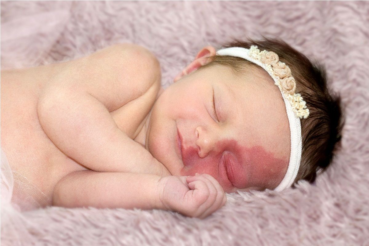 Родимые пятна у новорожденных: причины появления и когда опасны